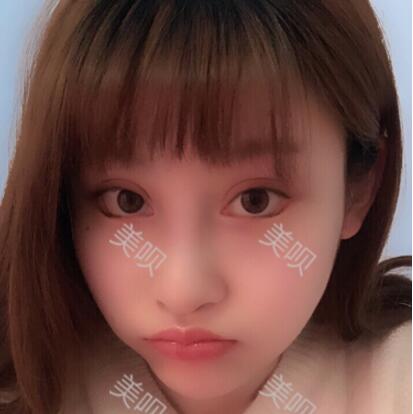 來看看我自體脂肪面部填充后變瓜子臉的銳變過程
