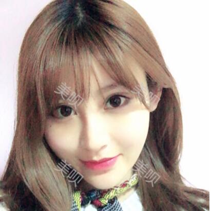 來看看我自體脂肪面部填充后變瓜子臉的銳變過程