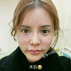 埋蛋白線.提升面部對比圖片，顏值嘩嘩嘩的往上漲!!!