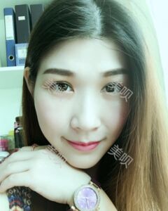 在廣州締妍做了內切去眼袋后年輕多了