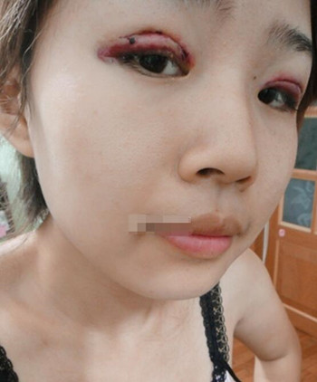 你們來看看藝美門智和做的埋線雙眼皮，瞬間變大眼美女
