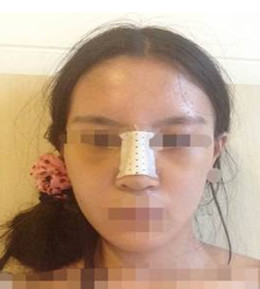 藝美門智和綜合隆鼻，你值得擁有