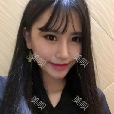 自從我玻尿酸隆鼻后吃飯逛街的回頭率飆升