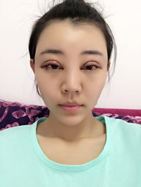 開外眼角手術(shù)前后過程對比圖片