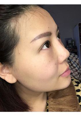 自體脂肪填充面部前后對(duì)比圖片，真的美了美了!