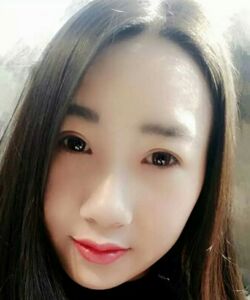 煙臺鵬愛魏璐做的全切雙眼皮，我也是大眼美女了