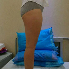 東方和諧馮斌做的大腿吸脂，給你們看看前后對比果圖片！