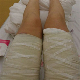 東方和諧馮斌做的大腿吸脂，給你們看看前后對比果圖片！