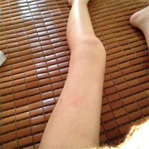 去東方和諧做了大腿抽脂，分享一下我的前后對比果圖片吧！