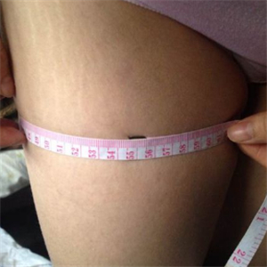 看看我大腿吸脂的前后對比果圖片吧，是東方和諧張準(zhǔn)做的