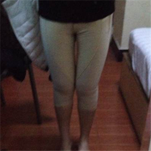 看看我大腿吸脂的前后對比果圖片吧，是東方和諧張準(zhǔn)做的