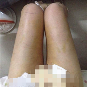 看看我大腿吸脂的前后對比果圖片吧，是東方和諧張準(zhǔn)做的