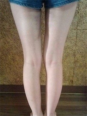 去年東方和諧張準(zhǔn)醫(yī)生做的大腿抽脂，分享一下我的前后對比果圖片！