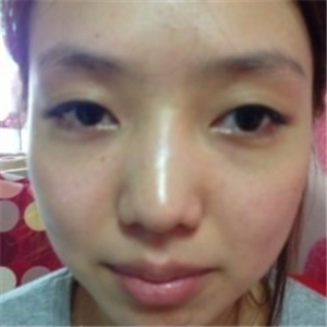 米揚(yáng)麗格夏正義做雙眼皮果怎么樣？看看我的前后對(duì)比果圖片吧！