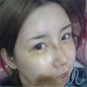 百*麗沈國雄做的隆鼻失敗修復(fù)，恢復(fù)果很好，還有前后對比照片！