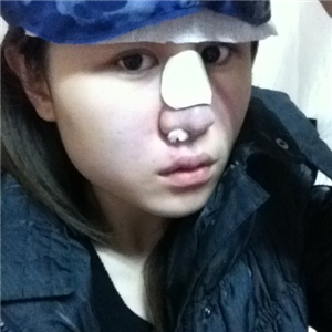 百*麗徐曉斐做的膨體假體隆鼻，給你們看看前后對(duì)比果圖片~