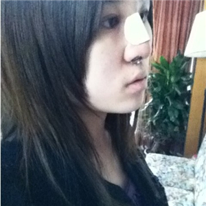百*麗徐曉斐做的膨體假體隆鼻，給你們看看前后對(duì)比果圖片~