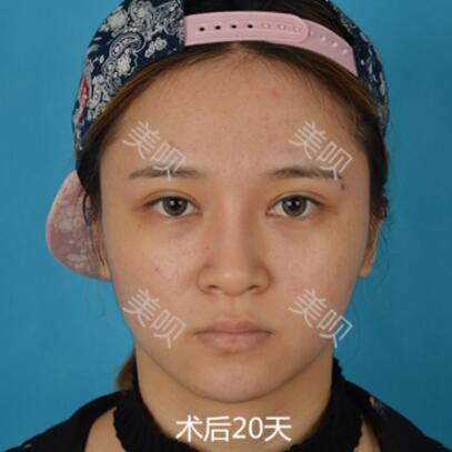 在成都藝美匯做的切開(kāi)雙眼皮+開(kāi)眼角果還可以吧