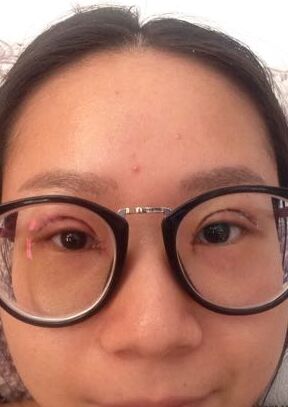 全切雙眼皮改良了我的內(nèi)雙腫泡眼，多虧了何賢清醫(yī)生