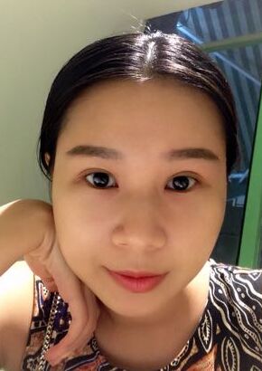 全切雙眼皮改良了我的內(nèi)雙腫泡眼，多虧了何賢清醫(yī)生