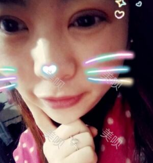 合肥壹加壹王大勇做的切開(kāi)雙眼皮分享給大家