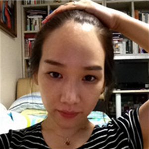 去年在格萊美做了頭發(fā)種植，看看前后對比和恢復果照片吧~~