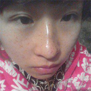 去格萊美做了激光去雀斑，有恢復(fù)前后的對比照片哦，還不錯~~