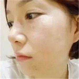 做了激光去雀斑前后對比照片分享，黃俊俊的技術(shù)很好哦！