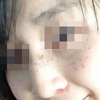 花費(fèi)4000元做了激光祛斑，終于把雀斑消滅了555555