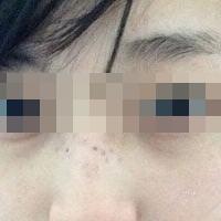 花費(fèi)4000元做了激光祛斑，終于把雀斑消滅了555555