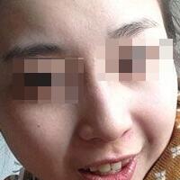 花費(fèi)4000元做了激光祛斑，終于把雀斑消滅了555555