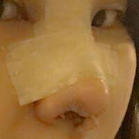 假體隆鼻，耳軟骨墊鼻尖，鼻頭縮小等隆鼻整形分享