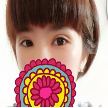 雙眼皮修復成功辣  再也不用擔心異樣的眼光辣