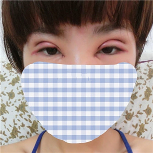 做park法雙眼皮手術(shù)一個月了，果很好，有恢復(fù)過程照片哦~~