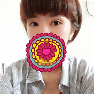 做park法雙眼皮手術(shù)一個月了，果很好，有恢復(fù)過程照片哦~~