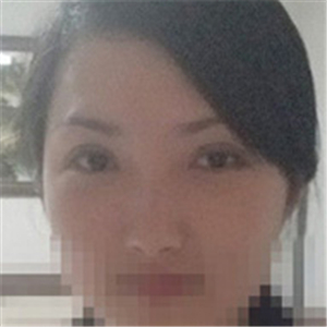 楊亞益醫(yī)生做的雙眼皮+開眼角，果不錯，看看我的恢復(fù)照片~~~