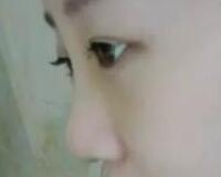同學(xué)做了隆鼻，我也去做了個假體隆鼻，臉型真心立體了好多