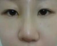 同學(xué)做了隆鼻，我也去做了個假體隆鼻，臉型真心立體了好多