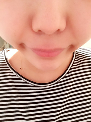 玻尿酸去除法令紋后人生明朗了 軍美王世虎做的