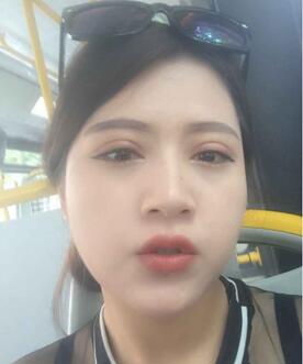 廣州麗尚做的全切開(kāi)雙眼 變身混血兒