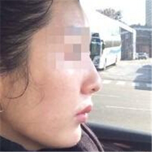 打B****告別大餅?zāi)槪謴?fù)前后的對(duì)比果照片給你們看看哦