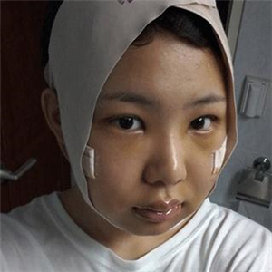 磨下頜角磨骨手術(shù)一個月了，分享一下恢復(fù)前后的果照片哇~
