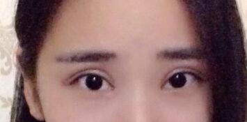 切開雙眼皮價(jià)格2680元，割雙眼皮拆線后圖片