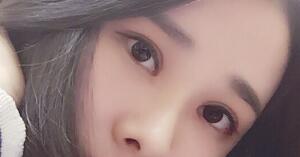 切開雙眼皮兩個(gè)辦月了