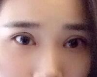 切開雙眼皮價格2680元，費用不貴果卻很好