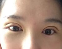 割雙眼皮過程恢復(fù)圖分享給大家，單眼皮變雙眼皮