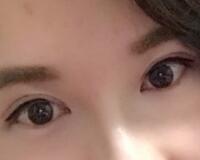 割雙眼皮過程恢復(fù)圖分享給大家，單眼皮變雙眼皮