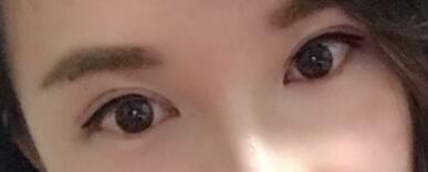 割雙眼皮過程恢復(fù)圖分享給大家，單眼皮變雙眼皮