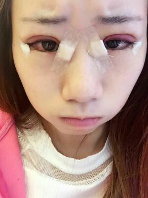 做了全切雙眼皮和開內(nèi)眼角，術(shù)后果較為滿意