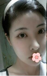 做了磨顴骨手術(shù)的我從小鴨子變成白天鵝 謝謝柳大烈教授